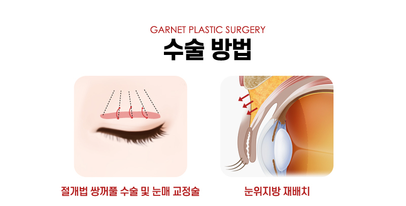 【가넷성형외과 백인수원장 성형칼럼】 쌍꺼풀재수술 (겹주름제거와 눈매교정술) 케이스 관련 이미지 6