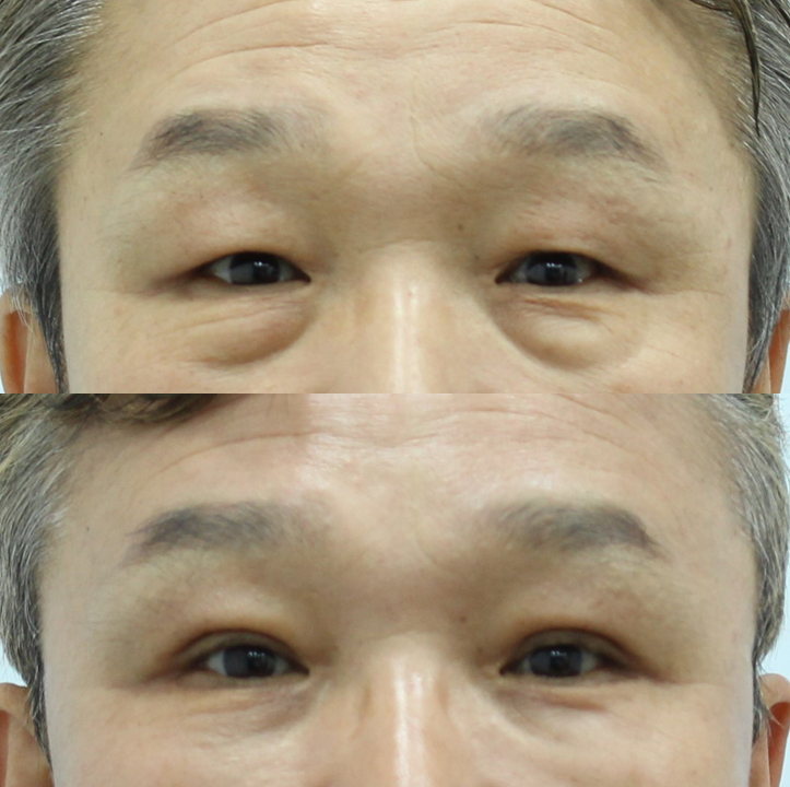 Recovery Process and Natural Impression Changes After Upper and Lower Eyelid Surgery in a Man in His 50s image 5