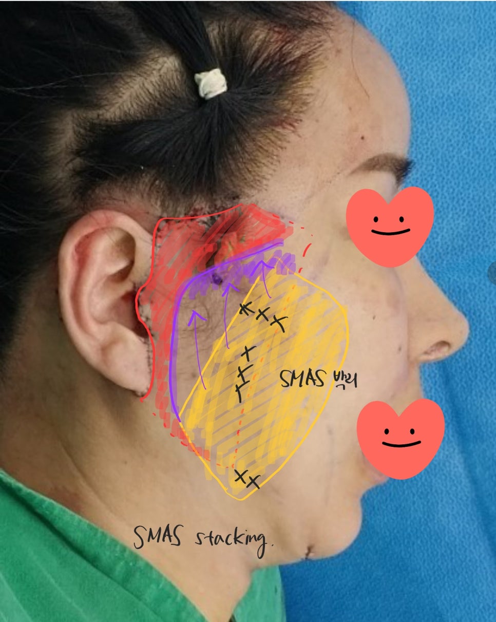 Sagging Skin After Facial Contouring Surgery (Cheek Sagging) image 4