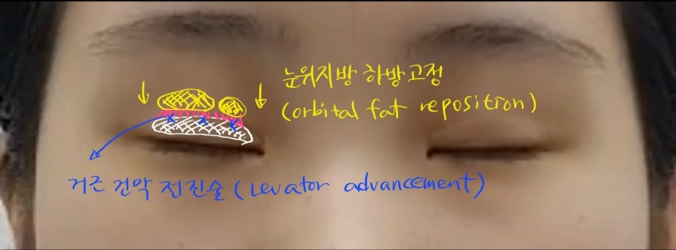 안검하수가 동반된 짝눈의 쌍꺼풀 재수술 관련 이미지 7