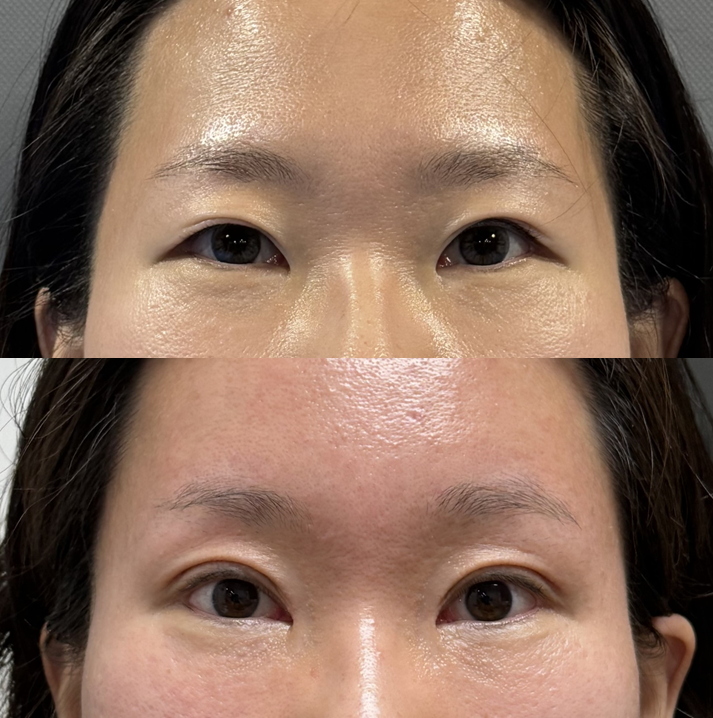 Why Forehead Lift and Double Eyelid Surgery Are Performed Together in Younger People image 3