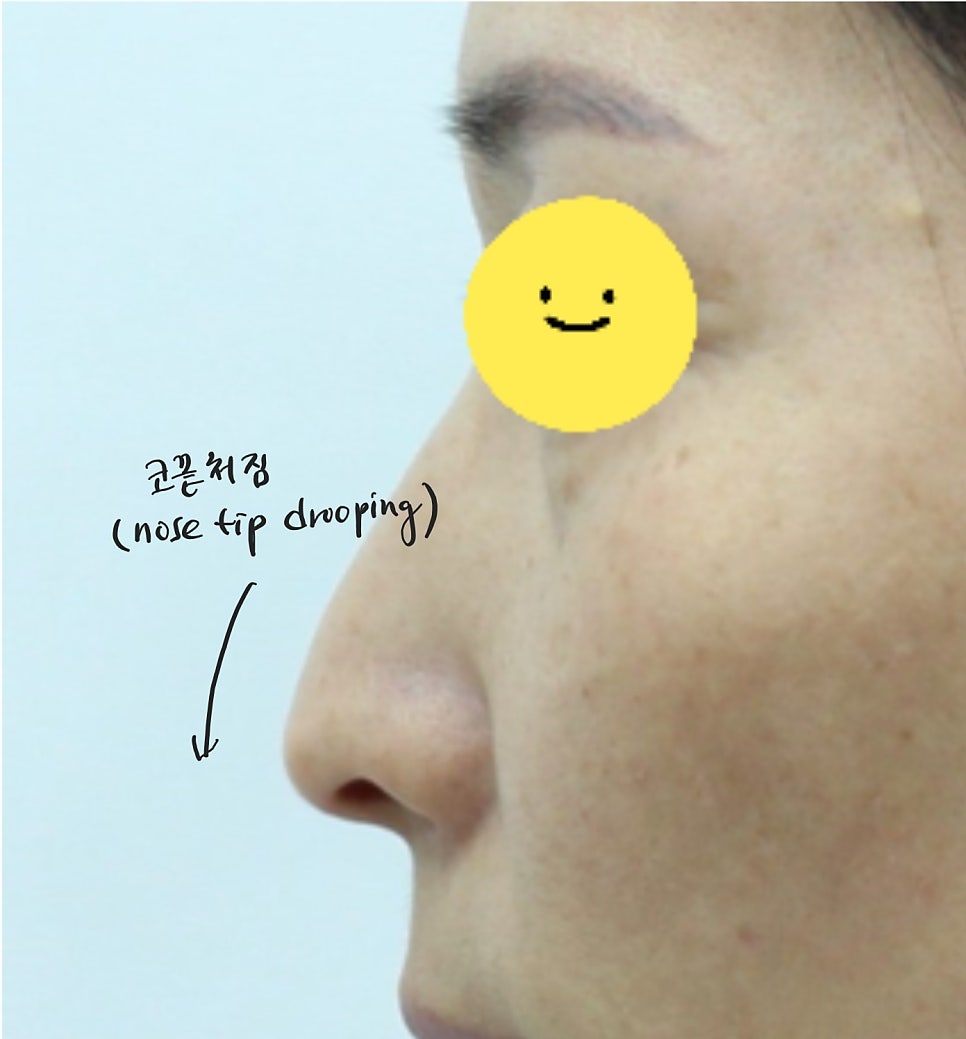 The Aging Process of the Nose and Midlife Rhinoplasty image 5