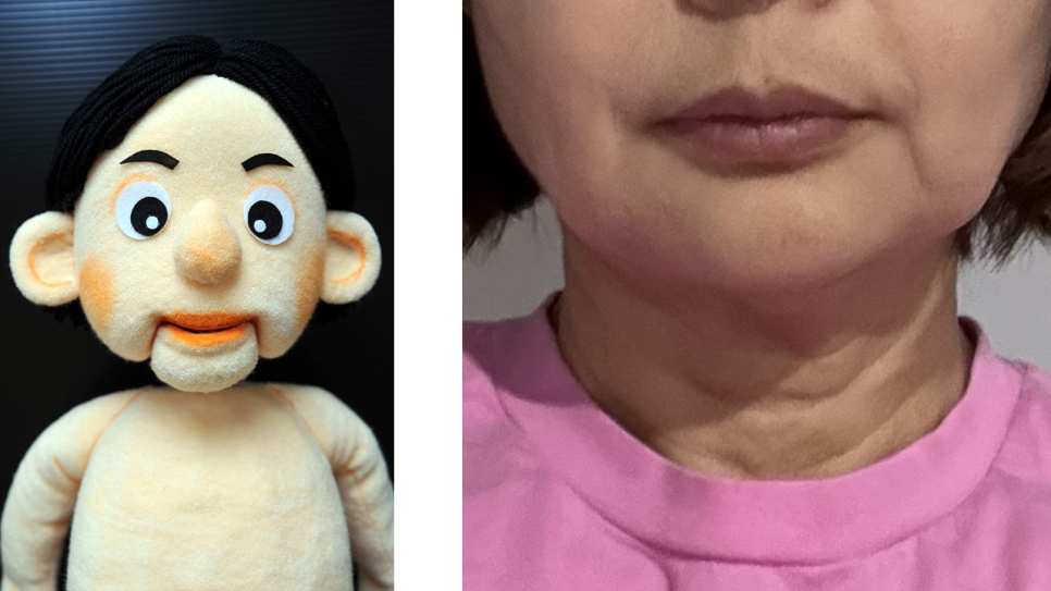 입가 주름 리프팅, 마리오네트 라인 개선하는 방법 관련 이미지 2