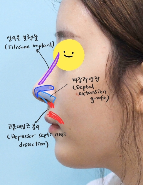 중안면이 긴 얼굴의 코성형과 지방이식 관련 이미지 4