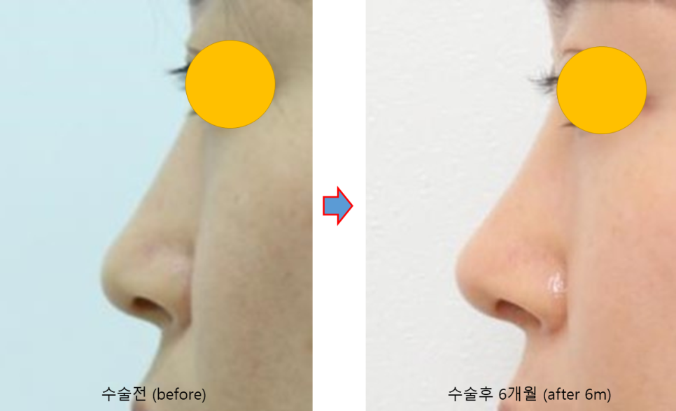 무보형물 코성형, 휜코까지 교정할 수 있을까? 관련 이미지 4
