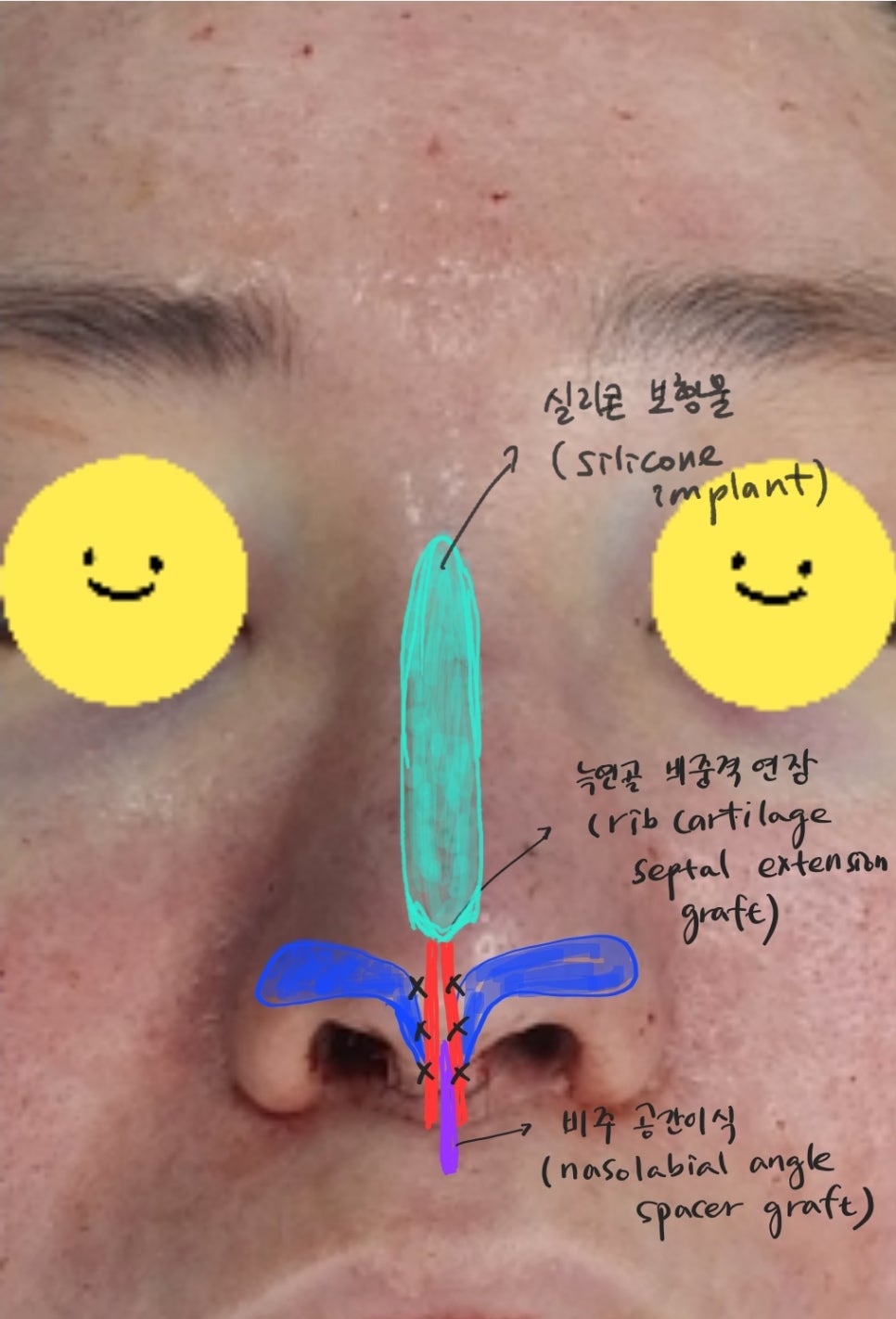 늑연골을 이용한 비주함몰의 교정 관련 이미지 7