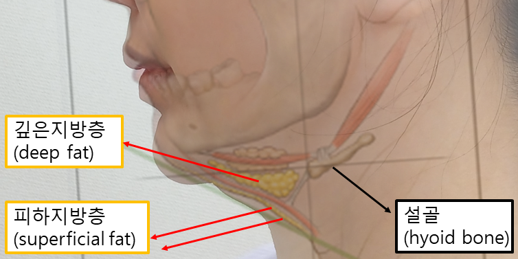 The Evolution of Double-Chin Surgery: From Liposuction to Pelican Surgery image 1