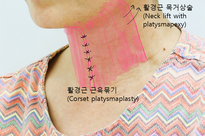 안면거상과 함께하는 두가지 목거상술 관련 이미지 5