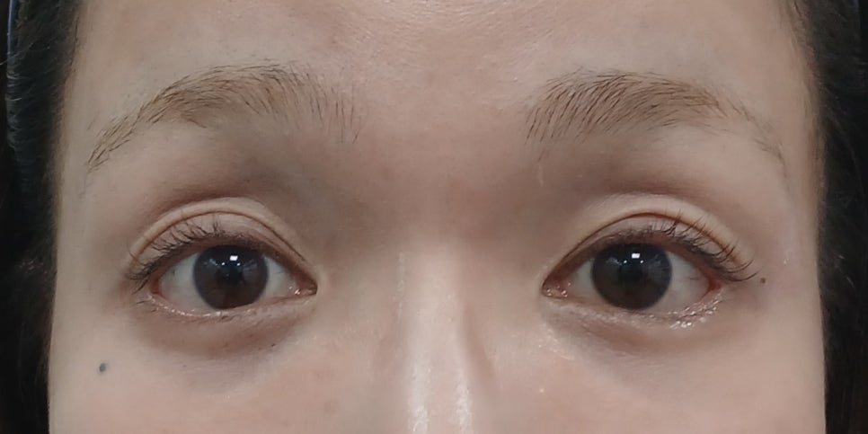 눈주변 지방이식, 채취부터 이식까지 섬세하게 진행되는 자연스러운 변화 관련 이미지 3