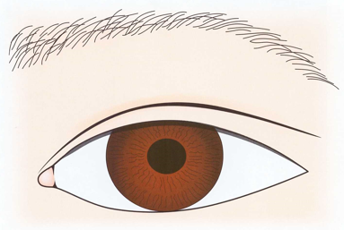 Two-Way Epicanthoplasty for a Cool Semi-Outlook Line image 3