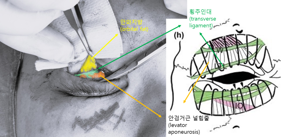 시원한 눈매를 위한 눈매교정 관련 이미지 5