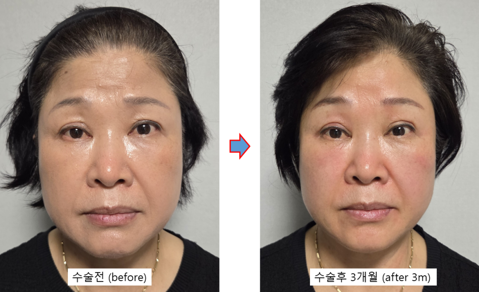 상안검 수술 후에도 눈이 불편하다면? &ndash; 눈 재수술과 이마거상을 함께 하는 이유 관련 이미지 4