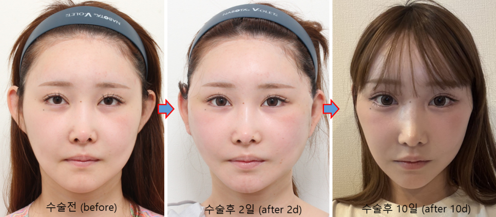 안면윤곽수술 후 피부처짐, 맞춤형 거상수술이 필요한 이유 관련 이미지 7