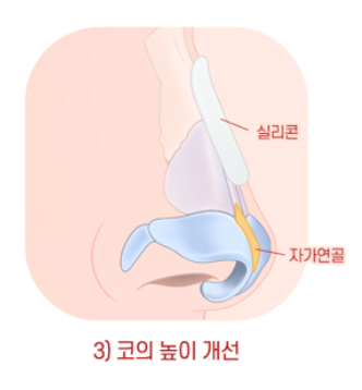 Male Rhinoplasty Performed Alongside Septoplasty image 3
