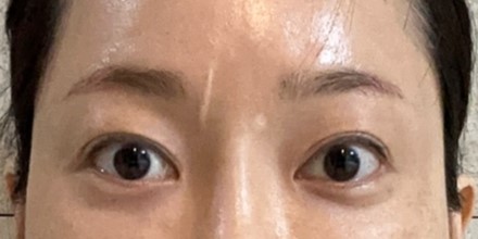 흉터성형과 흉터성숙, 시간이 지나면 흉터는 어떻게 변할까요? 관련 이미지 3