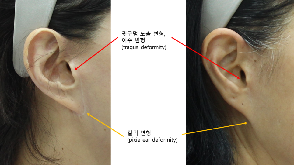 안면거상후 흉터 성숙과정 관련 이미지 3