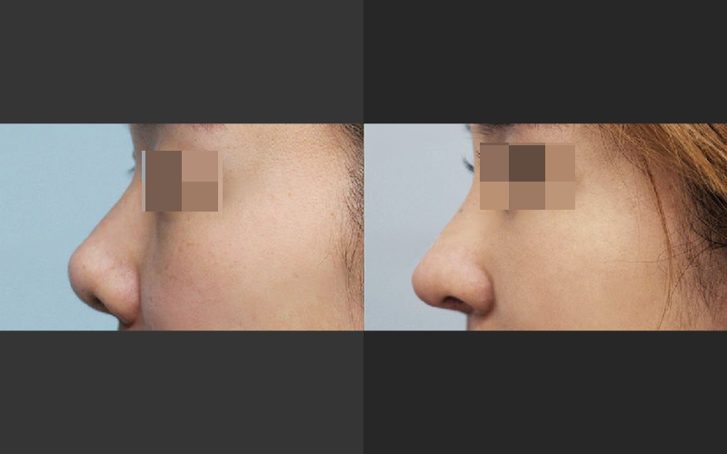 Lengthening Revision Rhinoplasty for a Short, Upturned Nose image 8