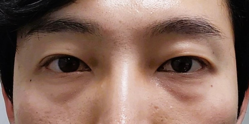 남자도 애교살을 만드나요? 관련 이미지 4