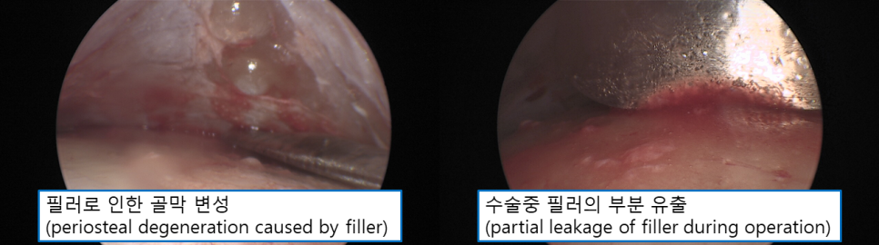 이마 필러를 맞았는데, 이마거상 수술이 가능할까요? 관련 이미지 4