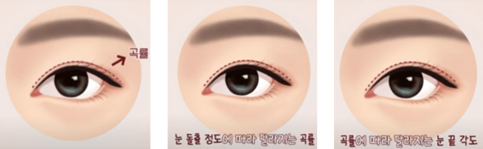 눈 아래부분을 화려하게 만드는 눈성형 관련 이미지 4