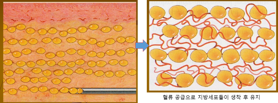 눈밑지방재배치와 애교살지방이식의 유지기간 관련 이미지 5