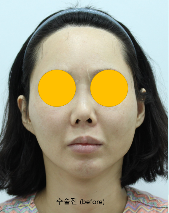 Cheek Sagging After Cheekbone Reduction Surgery? image 2