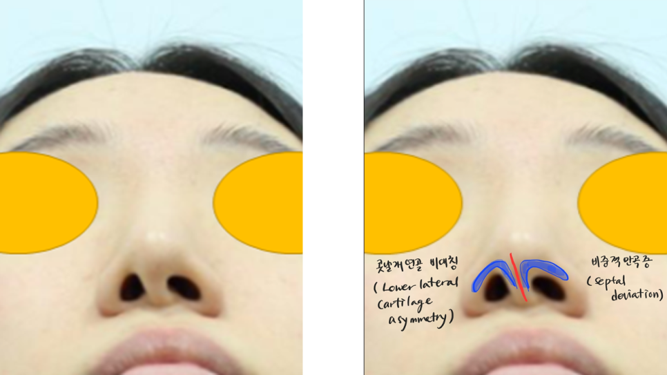 Various Surgical Methods for Crooked Nose Surgery image 2