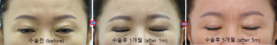 쌍꺼풀 재수술 흉터, 피부결을 따라야 자연스럽습니다 관련 이미지 7