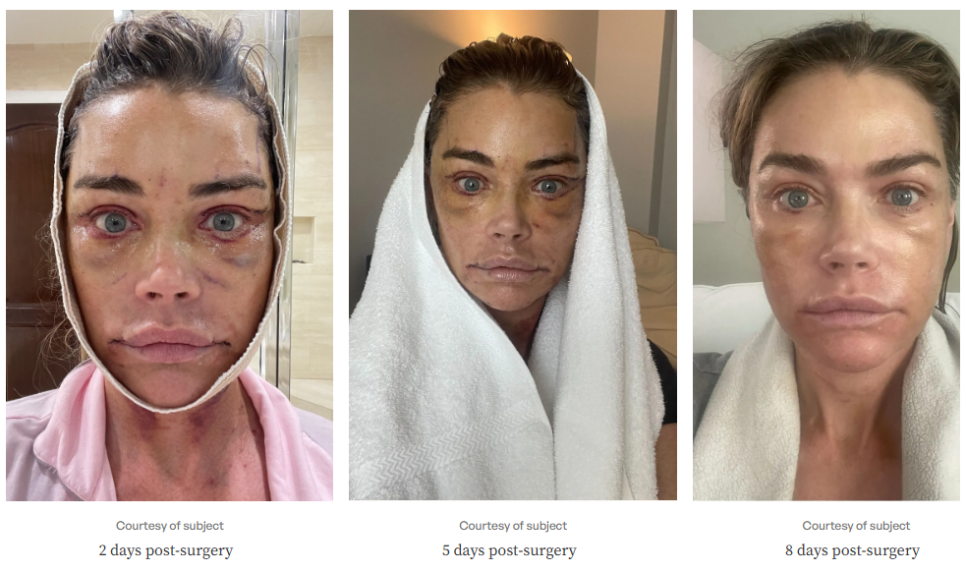 The Result of the $200,000 Anti-Aging Surgery Chosen by a Hollywood Star image 5