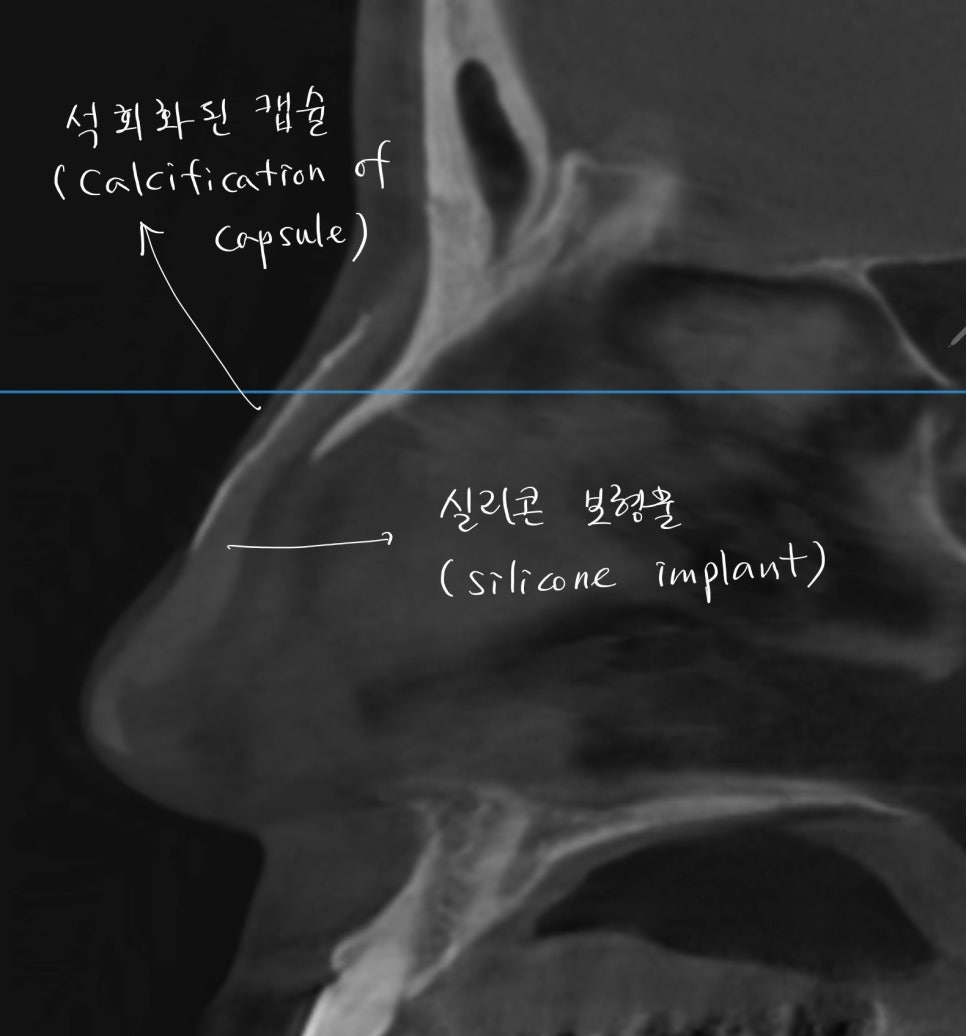 석회화된 실리콘 교체 후 얇아진 피부를 보강하는 코재수술 관련 이미지 2