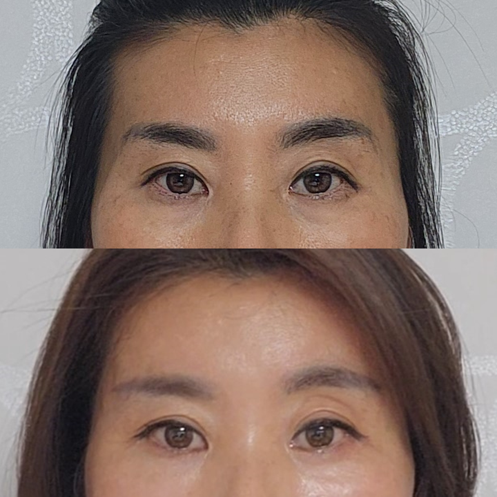 꺼진 관자와 납작한 이마, 지방이식으로 부드러운 인상 변화 관련 이미지 7