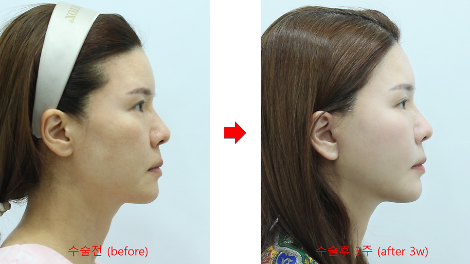 Correcting Cheek Sagging and Sunken Cheeks After Facial Contouring Surgery image 8
