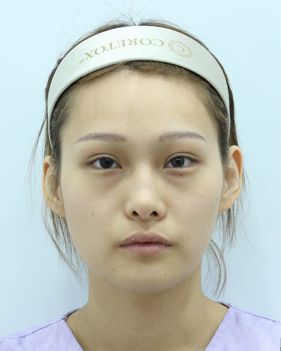 자연스러운 볼륨감을 위한 지방이식 관련 이미지 1