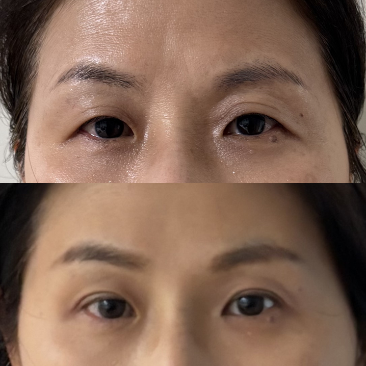 50대 쌍꺼풀 수술, 이마거상과 함께해야 자연스러운 이유 관련 이미지 5
