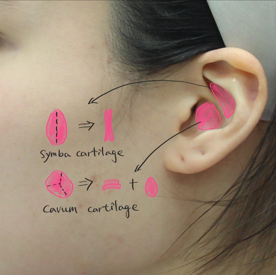 Precautions When Using Ear Cartilage in Rhinoplasty image 2
