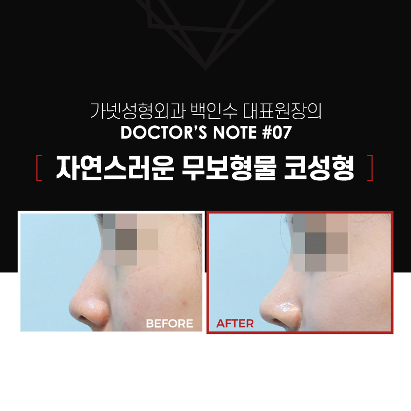 【가넷성형외과 백인수원장 성형칼럼】 매부리코 무보형물코성형 관련 이미지 2