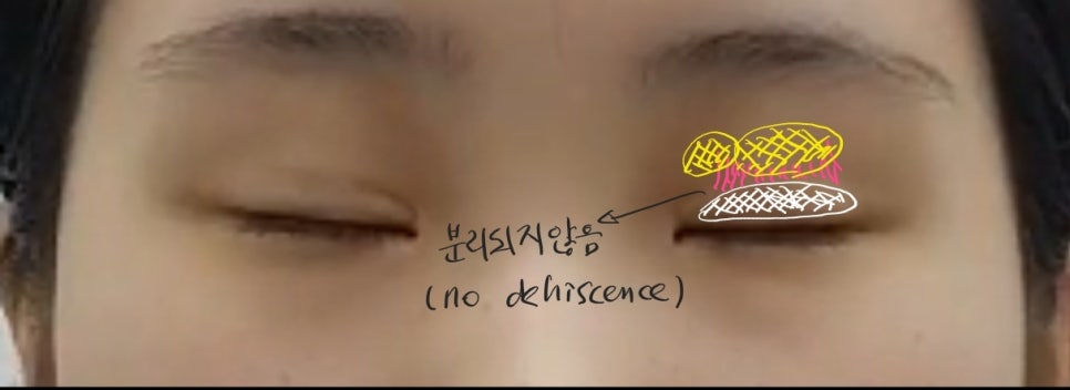 안검하수가 동반된 짝눈의 쌍꺼풀 재수술 관련 이미지 6