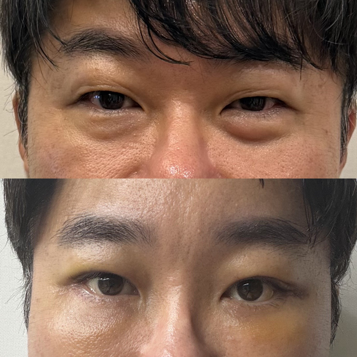 직장인 상하안검 수술, 연휴를 이용해 회복할 수 있을까? 관련 이미지 6