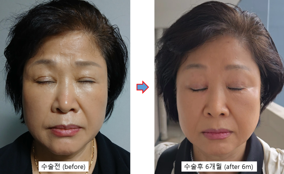 쌍꺼풀 재수술, 함몰흉터는 개선되고 눈은 편해졌습니다 - 6개월 흉터 성숙 과정 관련 이미지 5