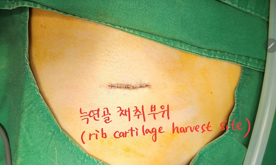 자가늑연골을 이용한 코 재수술 관련 이미지 3