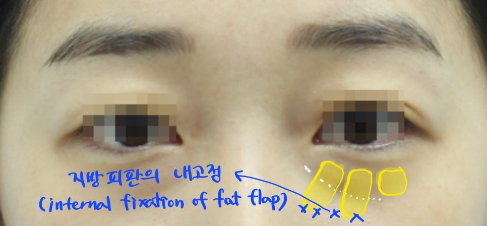 The Surgical Process of Lower Eyelid Fat Repositioning image 4