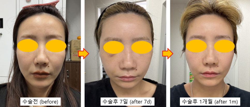A Deep Mini Facelift Case for a Japanese Patient Who Was Disappointed with the Longevity of Thread Lifting image 3