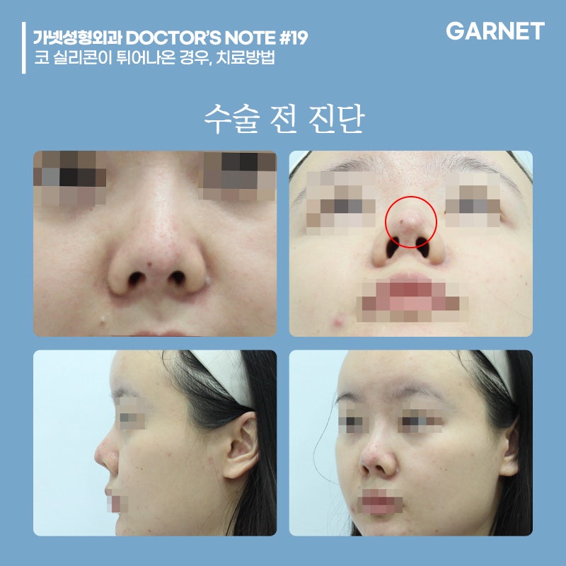 [가넷성형외과 백인수원장 성형칼럼] 코 실리콘이 튀어나온 경우, 치료방법 관련 이미지 2