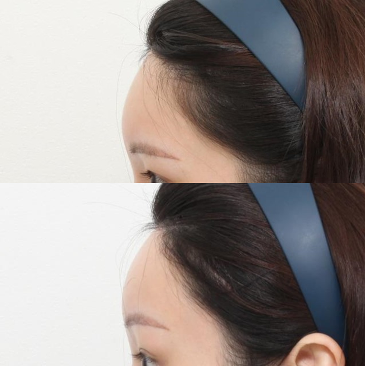 이마 필러를 맞았는데, 이마거상 수술이 가능할까요? 관련 이미지 5
