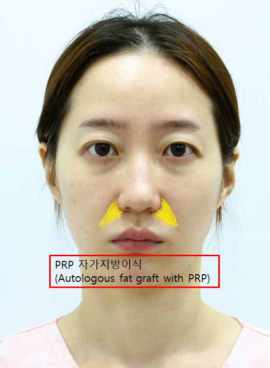 직장인들에게 가장 인기있는 성형 항목 관련 이미지 6