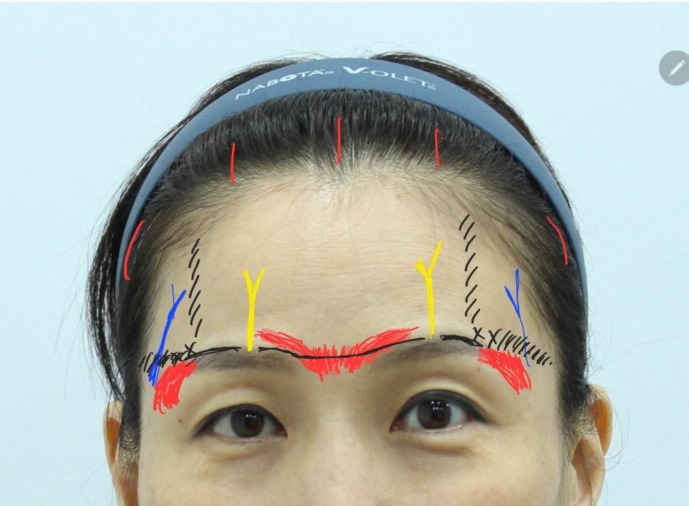 Forehead Lift to Correct Eyebrow Asymmetry image 4