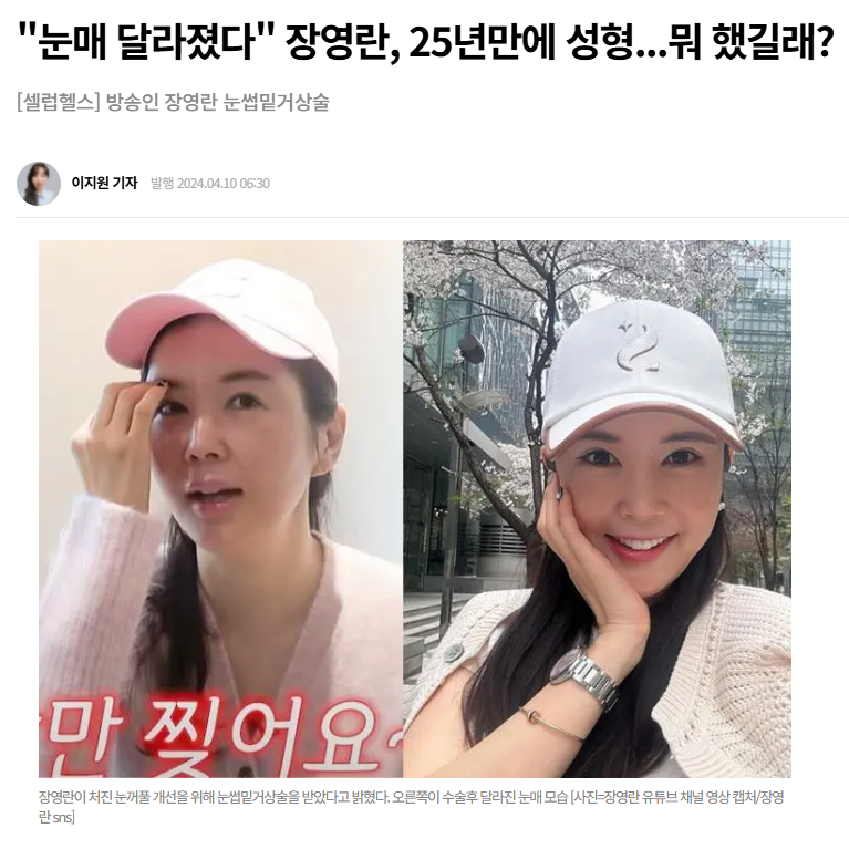 Jang Young-ran’s Brow Lift: Why It Made Her Look Younger, But Isn’t the Right Answer for Everyone image 1