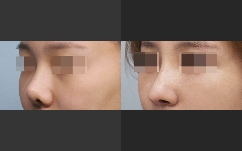 Lengthening Revision Rhinoplasty for a Short, Upturned Nose image 7