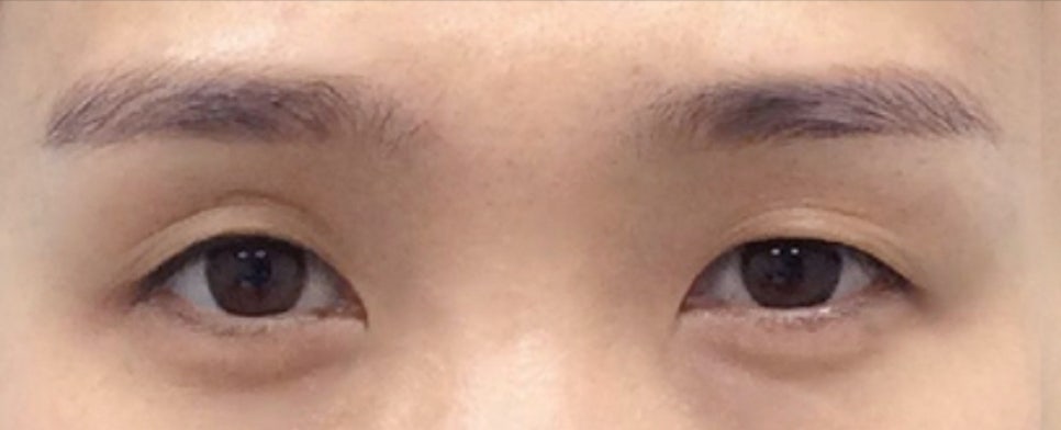 쌍꺼풀 수술에서 겹주름과 꺼진 눈 교정 관련 이미지 1