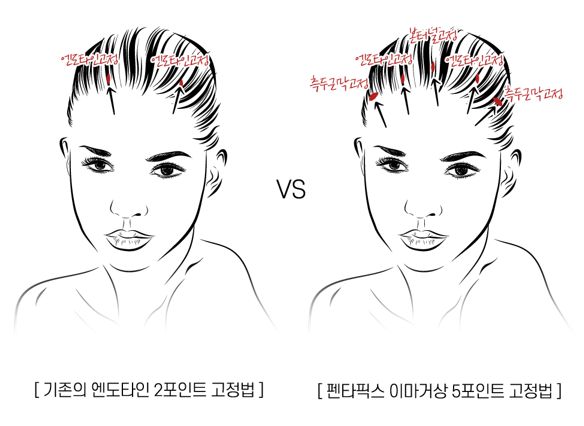 【가넷성형외과 백인수원장 성형칼럼】 펜타픽스이마거상으로 눈썹 비대칭 교정 관련 이미지 6